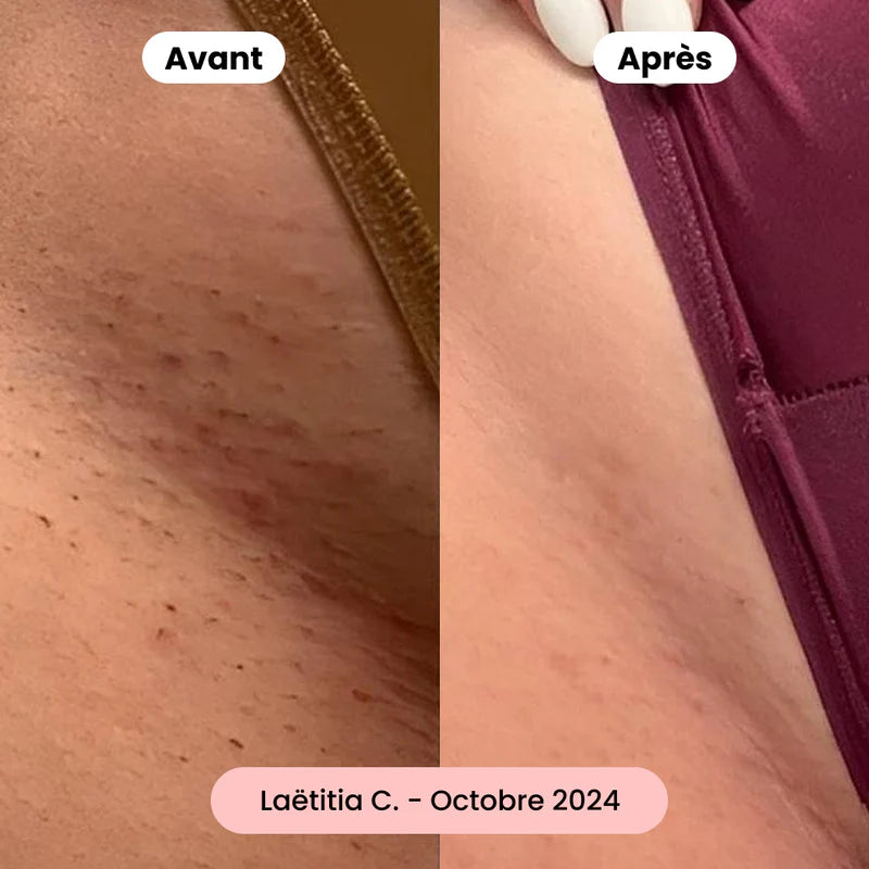 SilkyShave™ – Le rasoir doux pour une peau lisse sans irritation